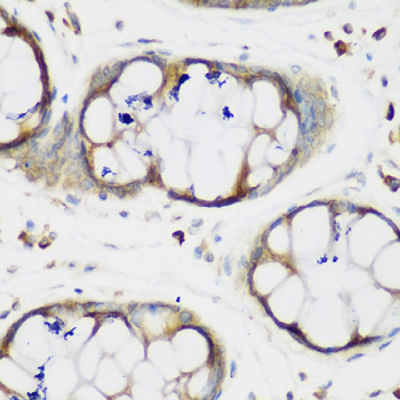 Immunohistochemistry of paraffin-embedded Human gastric using MTDH Polyclonal Antibody at dilution of  1:200 (40x lens).