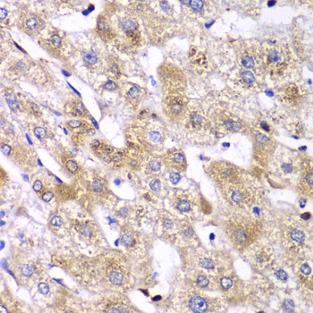 Immunohistochemistry of paraffin-embedded Human liver damage using RPS10 Polyclonal Antibody at dilution of  1:100 (40x lens).