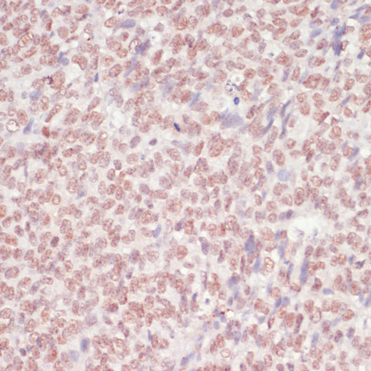 Immunohistochemistry of paraffin-embedded Human oophoroma using SNRNP70 Polyclonal Antibody at dilution of  1:100 (40x lens).