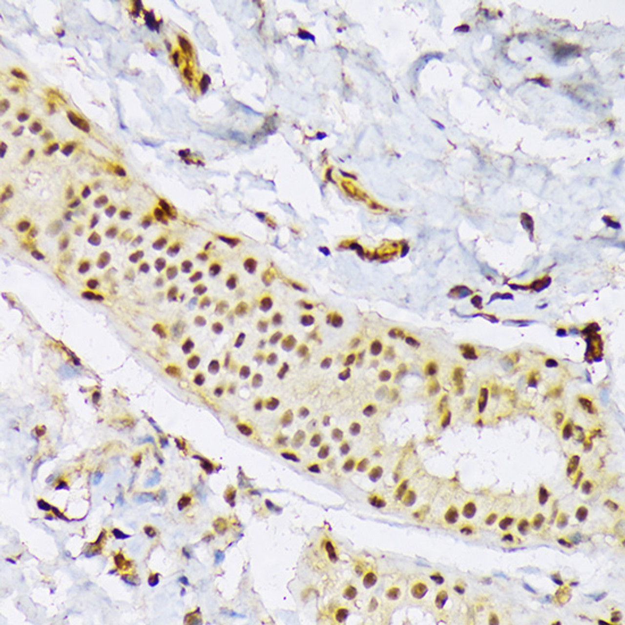 Immunohistochemistry of paraffin-embedded Human mammary cancer using SRSF3 Polyclonal Antibody at dilution of  1:100 (40x lens).