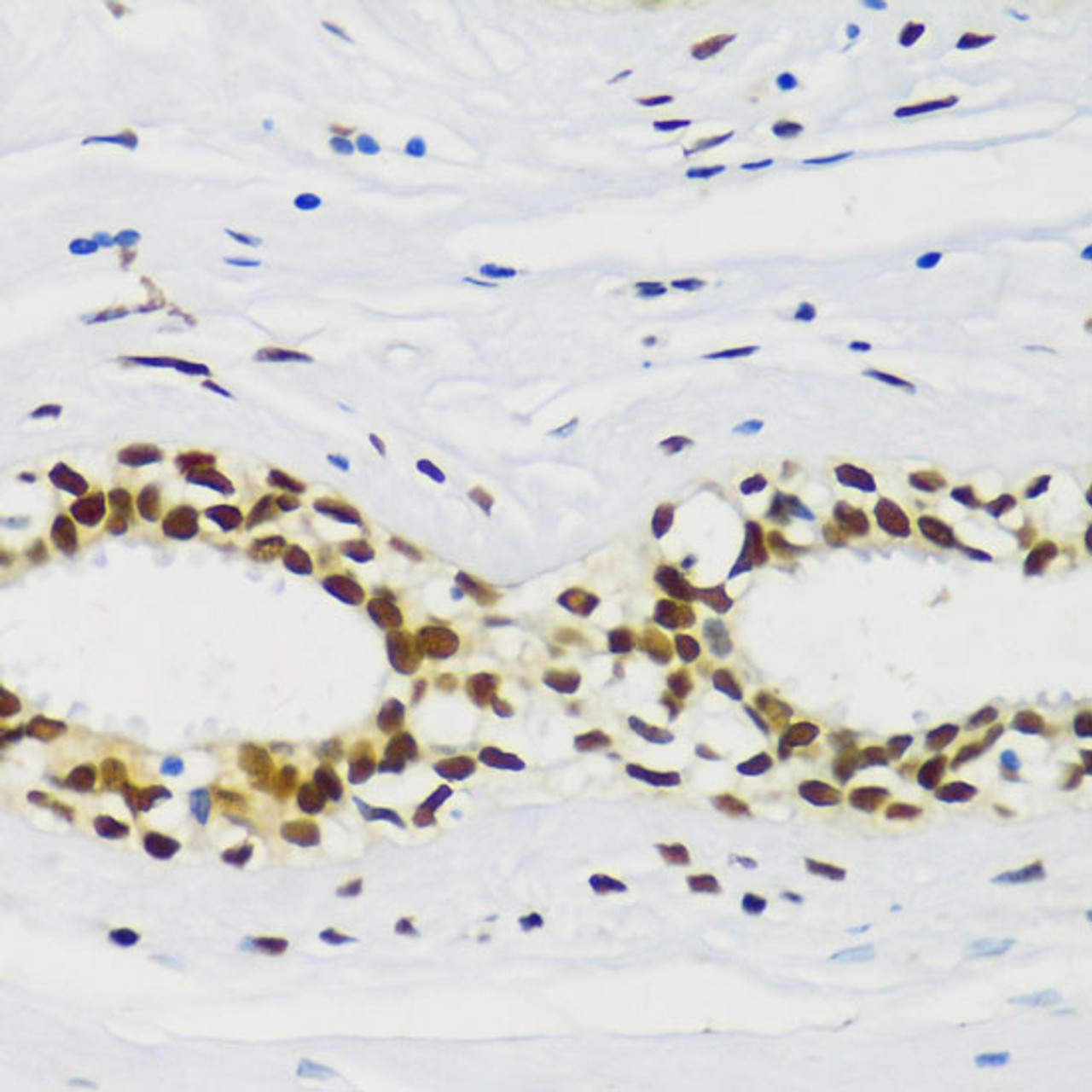Immunohistochemistry of paraffin-embedded Human breast cancer using CIRBP Polyclonal Antibody at dilution of  1:100 (40x lens).