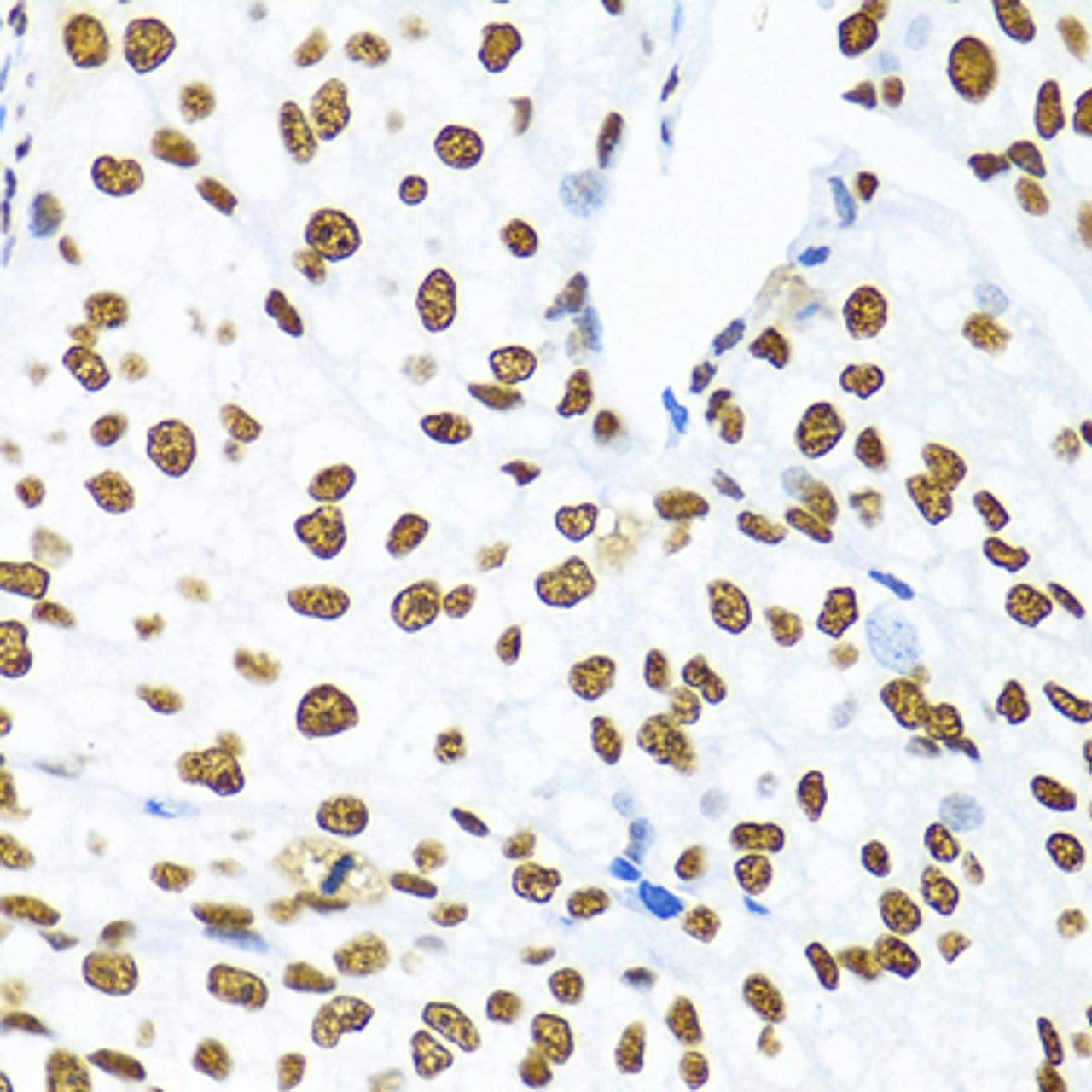 Immunohistochemistry of paraffin-embedded Human prostate cancer using KHDRBS1 Polyclonal Antibody at dilution of  1:100 (40x lens).