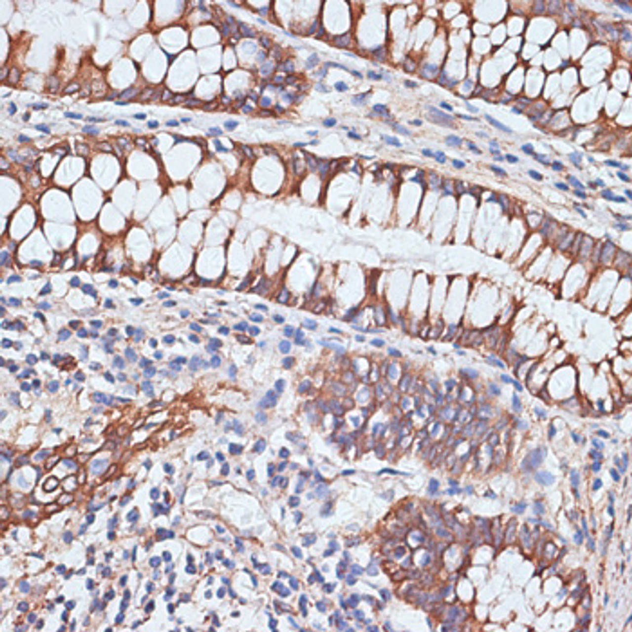 Immunohistochemistry of paraffin-embedded Human colon using PIGR Polyclonal Antibody at dilution of  1:100 (40x lens).