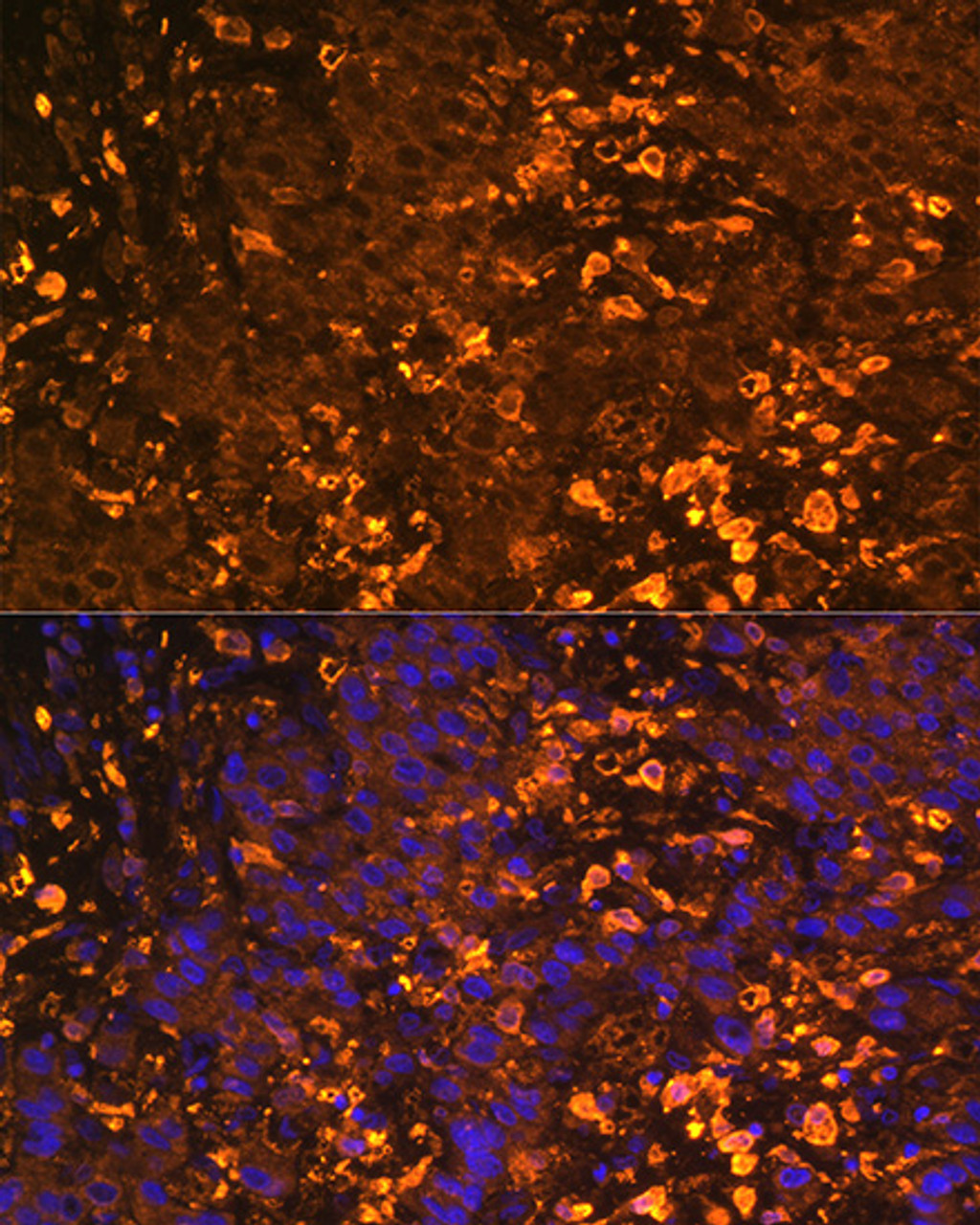 Immunofluorescence analysis of Human liver cancer using UGT1A1 Polyclonal Antibody at dilution of  1:100. Blue: DAPI for nuclear staining.