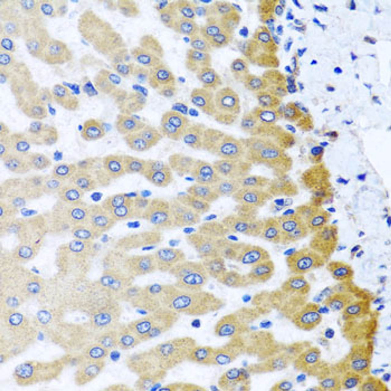 Immunohistochemistry of paraffin-embedded Human liver damage using M6PR Polyclonal Antibody at dilution of  1:100 (40x lens).