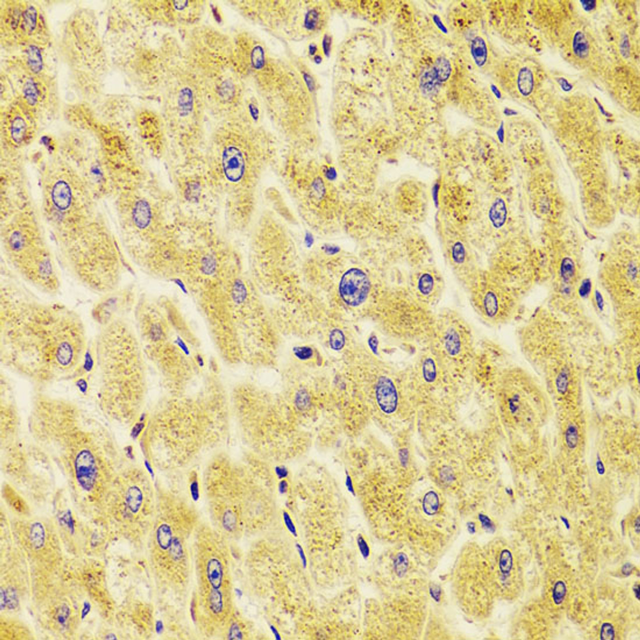 Immunohistochemistry of paraffin-embedded Human liver damage using TXNL1 Polyclonal Antibody at dilution of  1:100 (40x lens).