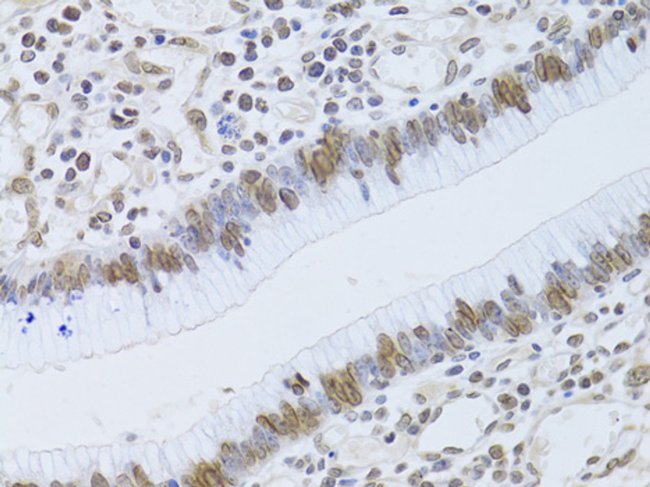 Immunohistochemistry of paraffin-embedded Human gastric cancer using LMNB2 Polyclonal Antibody at dilution of  1:100 (40x lens).