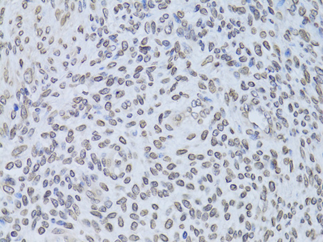 Immunohistochemistry of paraffin-embedded Human adenomyosis using LMNB2 Polyclonal Antibody at dilution of  1:100 (40x lens).