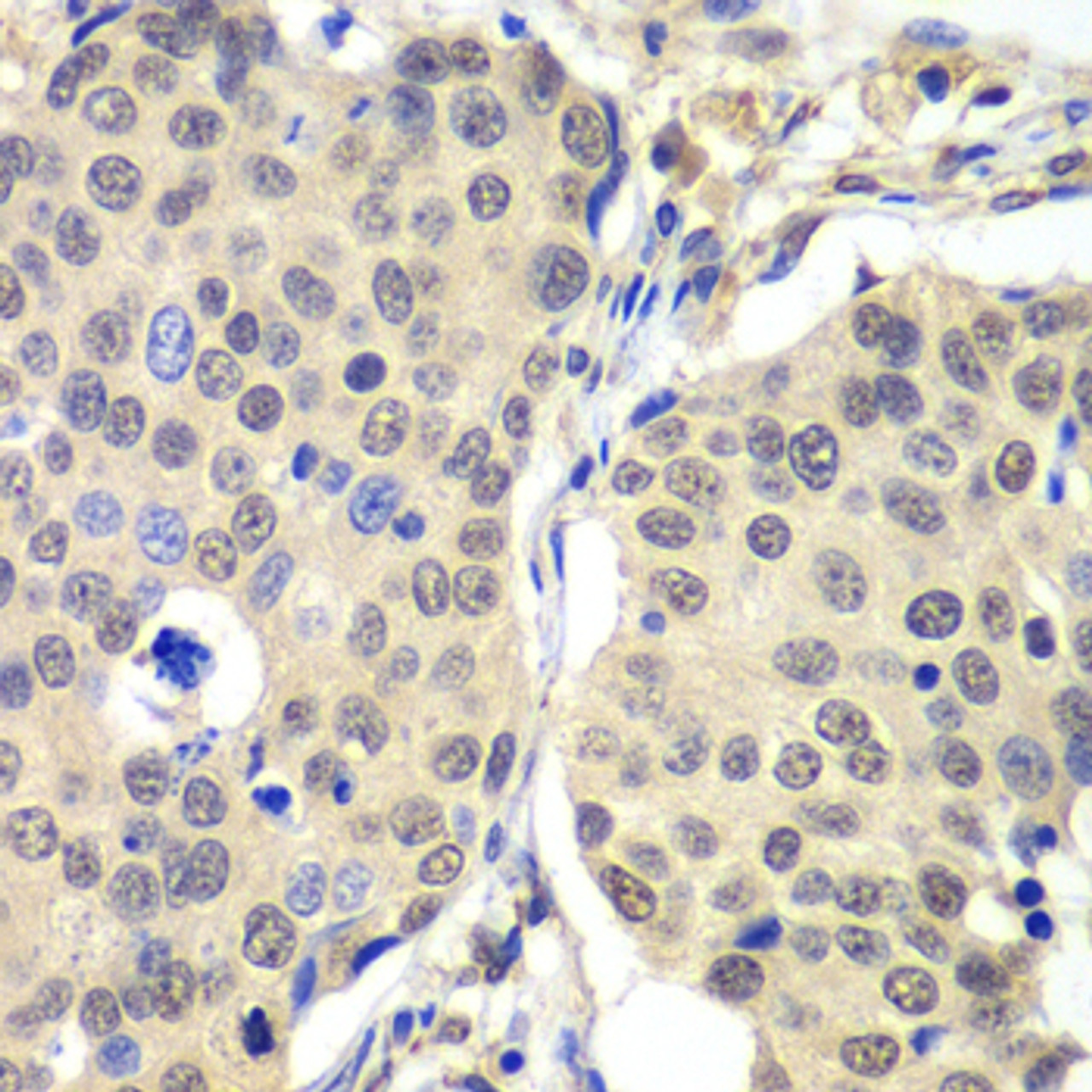 Immunohistochemistry of paraffin-embedded Human lung cancer using CCNC Polyclonal Antibody at dilution of  1:100 (40x lens).