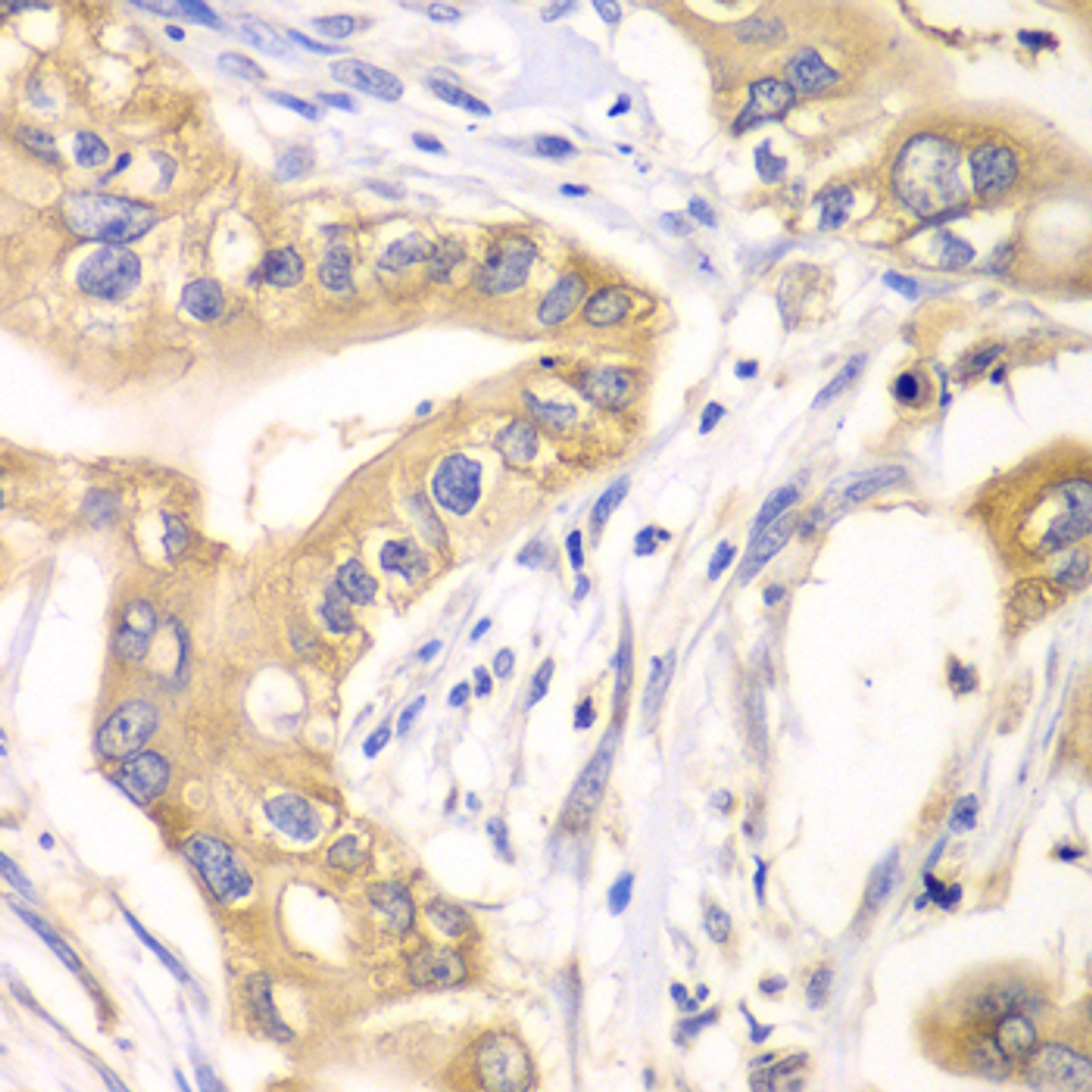 Immunohistochemistry of paraffin-embedded Human liver cancer using HAGH Polyclonal Antibody at dilution of  1:100 (40x lens).