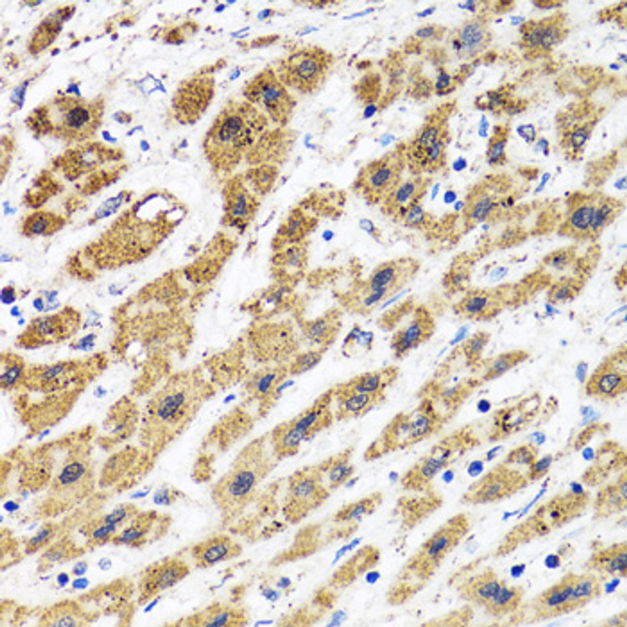 Immunohistochemistry of paraffin-embedded Human liver cancer using HAPLN1 Polyclonal Antibody at dilution of  1:100 (40x lens).