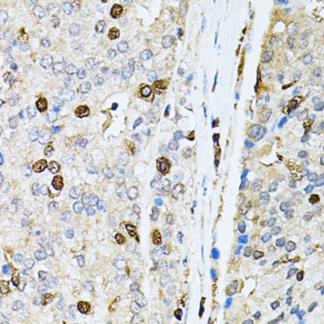 Immunohistochemistry of paraffin-embedded Human prostate cancer using PNKP Polyclonal Antibody at dilution of  1:100 (40x lens).