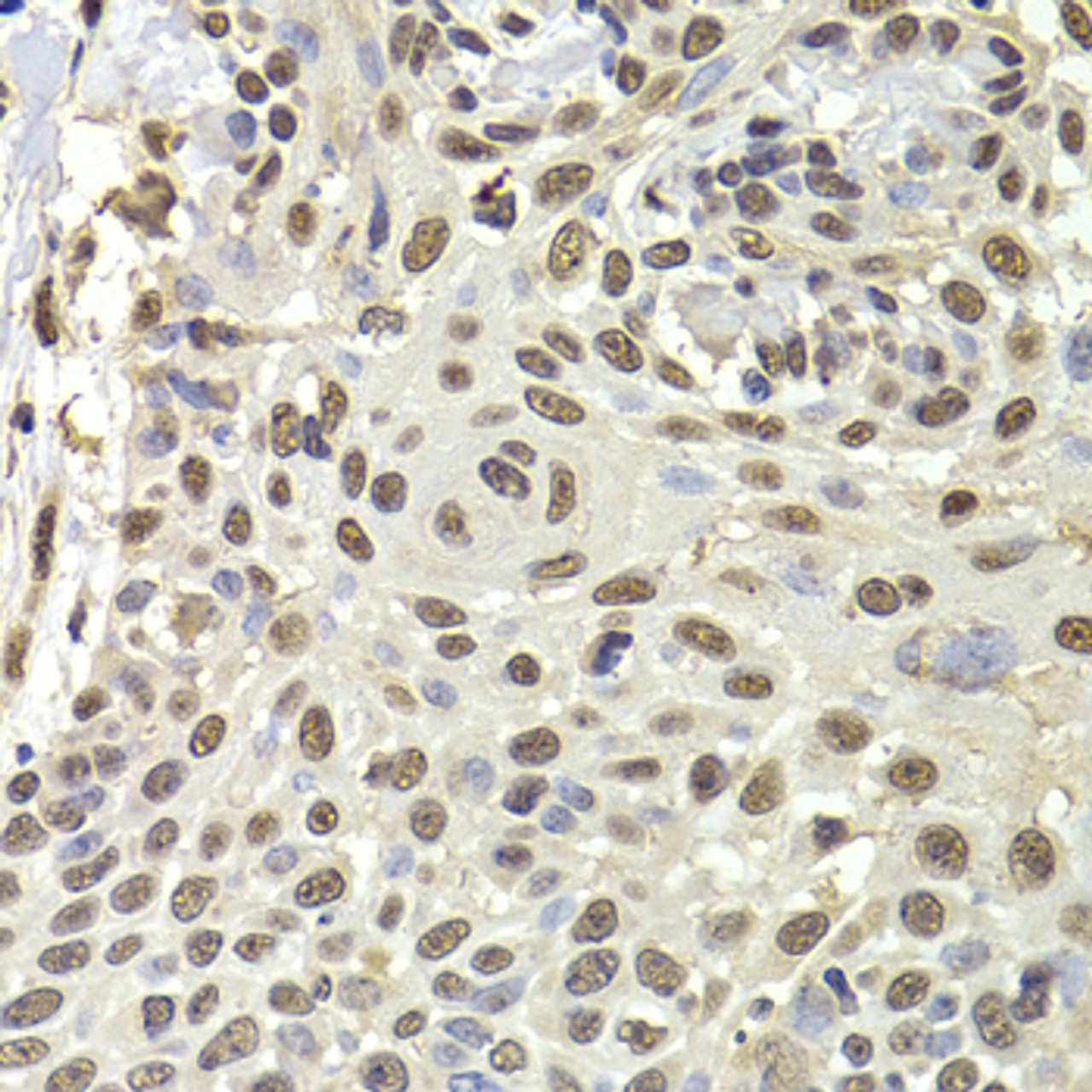 Immunohistochemistry of paraffin-embedded Human well-differentiated squamous skin carcinoma using PUF60 Polyclonal Antibody at dilution of  1:100 (40x lens).