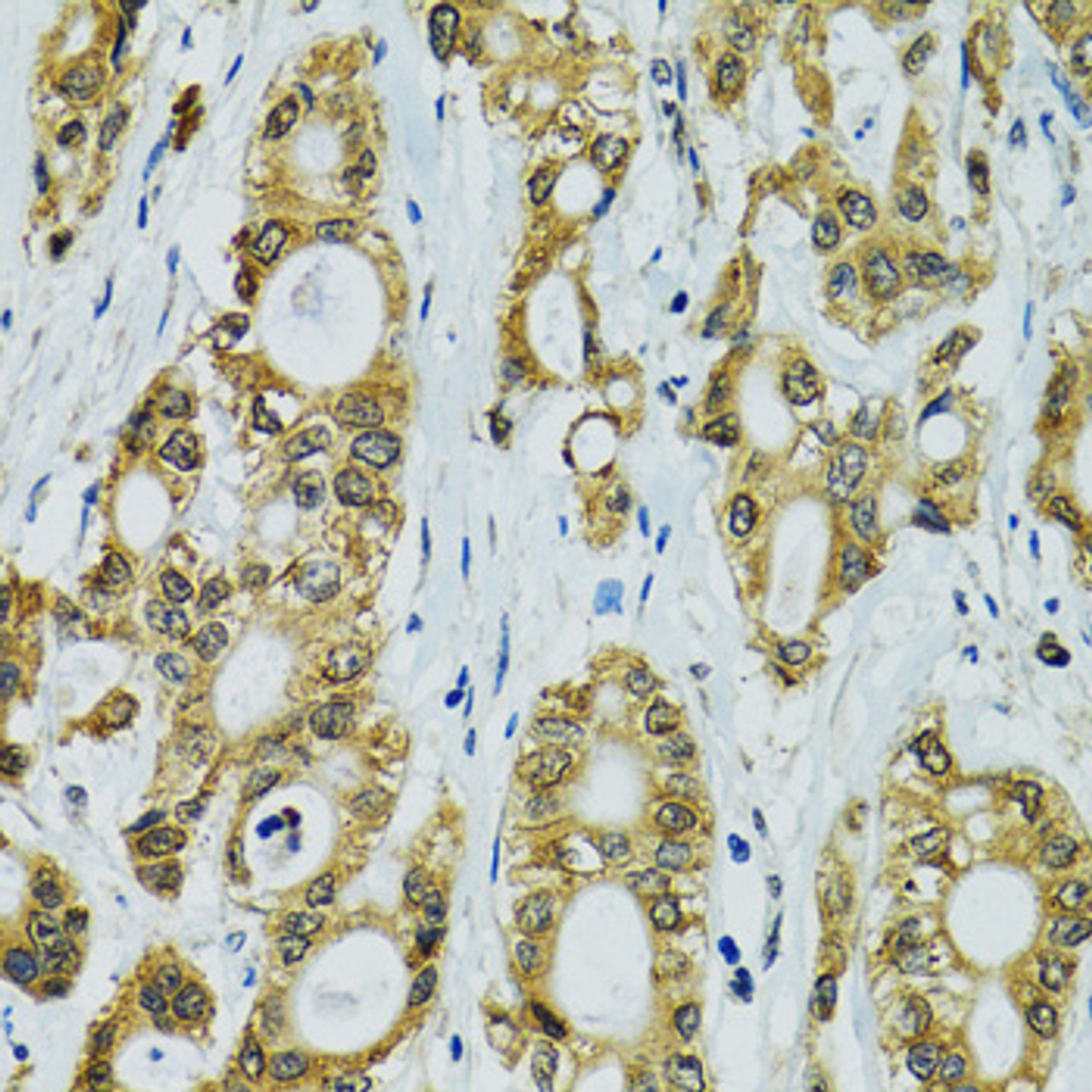 Immunohistochemistry of paraffin-embedded Human rectal cancer using RPS7 Polyclonal Antibody at dilution of  1:100 (40x lens).