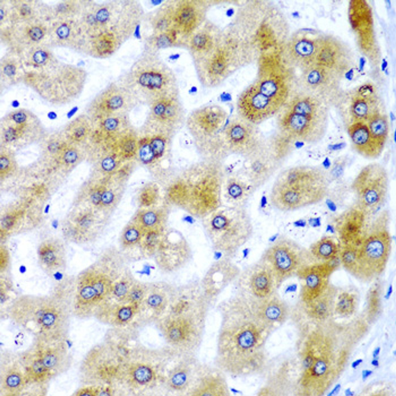 Immunohistochemistry of paraffin-embedded Human liver damage using SECISBP2 Polyclonal Antibody at dilution of  1:200 (40x lens).
