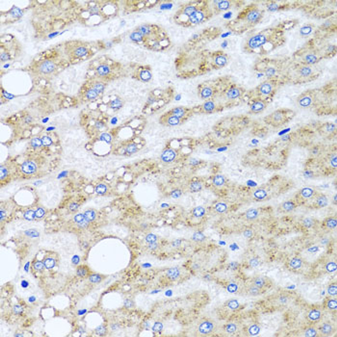 Immunohistochemistry of paraffin-embedded Human liver damage using SRI Polyclonal Antibody at dilution of  1:100 (40x lens).