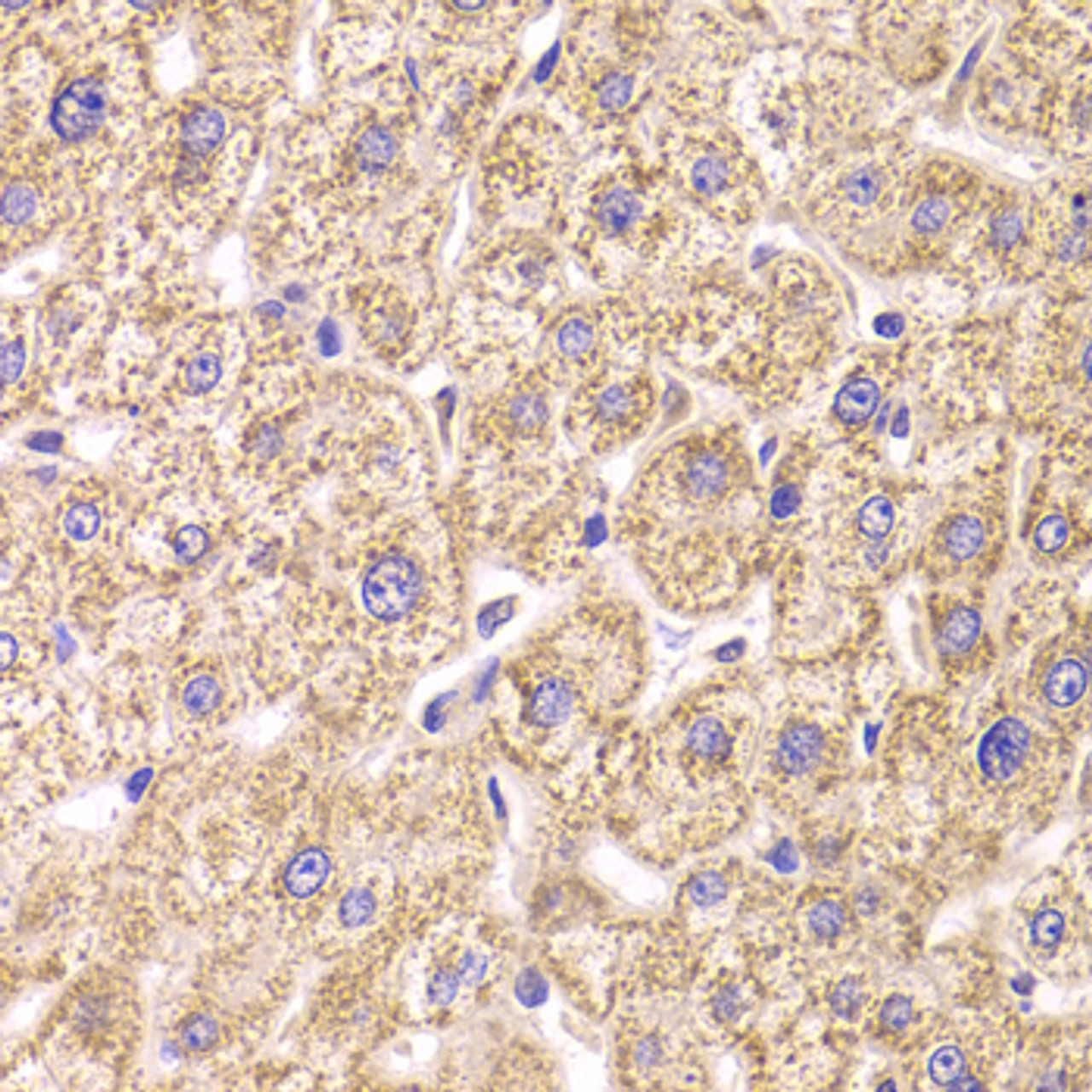 Immunohistochemistry of paraffin-embedded Human liver damage using ST3GAL3 Polyclonal Antibody at dilution of  1:100 (40x lens).