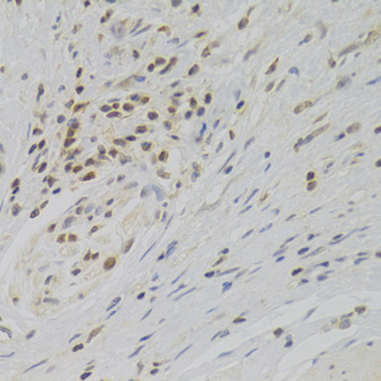 Immunohistochemistry of paraffin-embedded Human gastric cancer using TAF1C Polyclonal Antibody at dilution of  1:100 (40x lens).