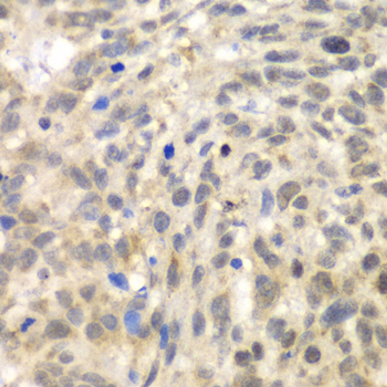 Immunohistochemistry of paraffin-embedded Human esophageal cancer using TLK2 Polyclonal Antibody at dilution of  1:100 (40x lens).