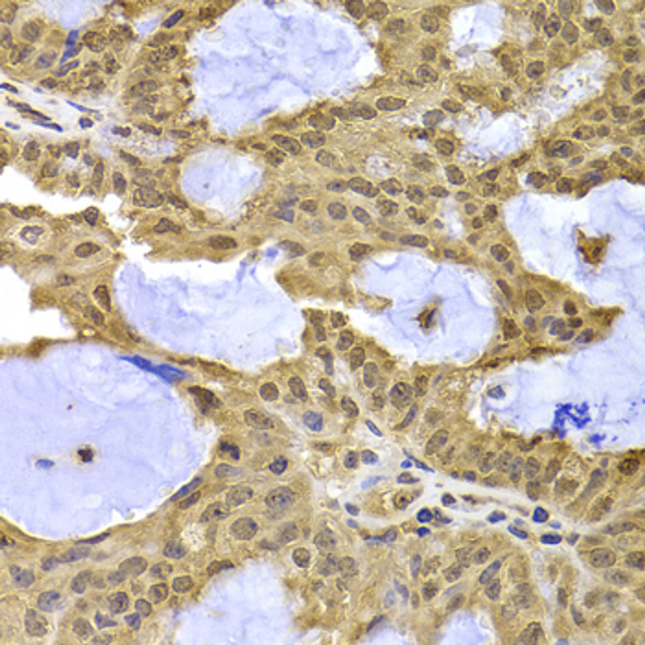Immunohistochemistry of paraffin-embedded Human oophoroma using XPO5 Polyclonal Antibody at dilution of  1:100 (40x lens).