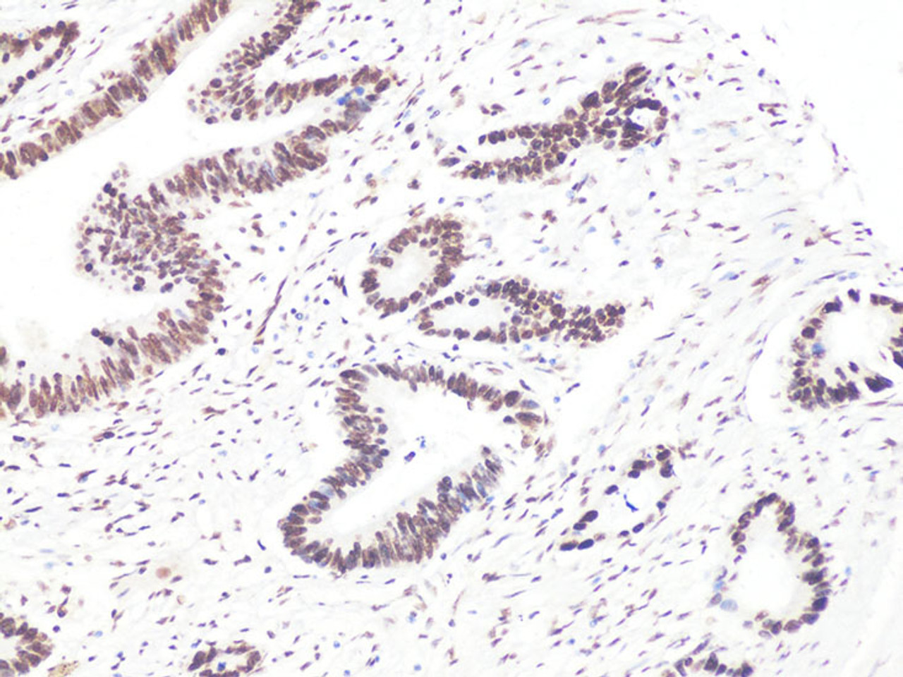 Immunohistochemistry of paraffin-embedded Human colon carcinoma using Bcl9 Polyclonal Antibody at dilution of  1:100 (20x lens).
