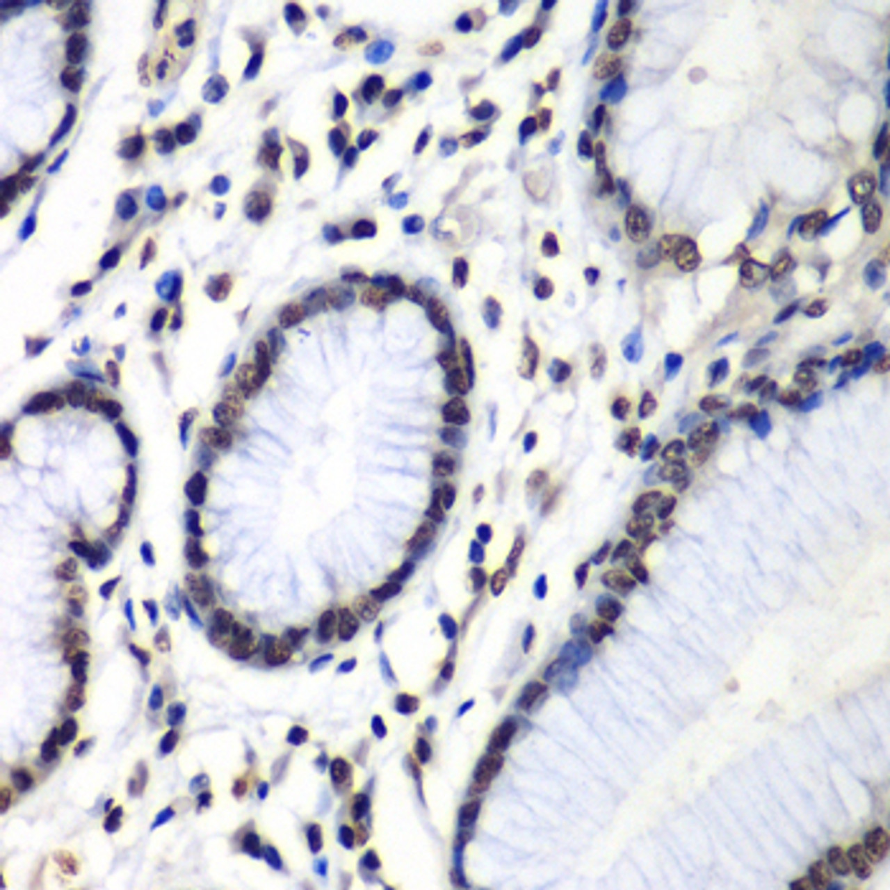 Immunohistochemistry of paraffin-embedded Human colon carcinoma using HNRNPM Polyclonal Antibody at dilution of  1:100 (40x lens).