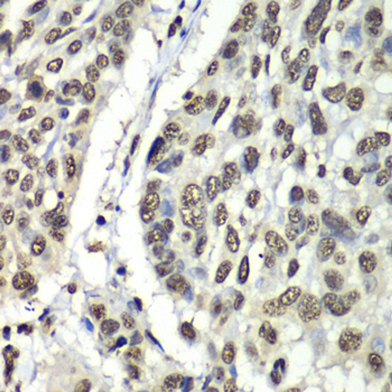 Immunohistochemistry of paraffin-embedded Human esophageal cancer using HNRNPM Polyclonal Antibody at dilution of  1:100 (40x lens).