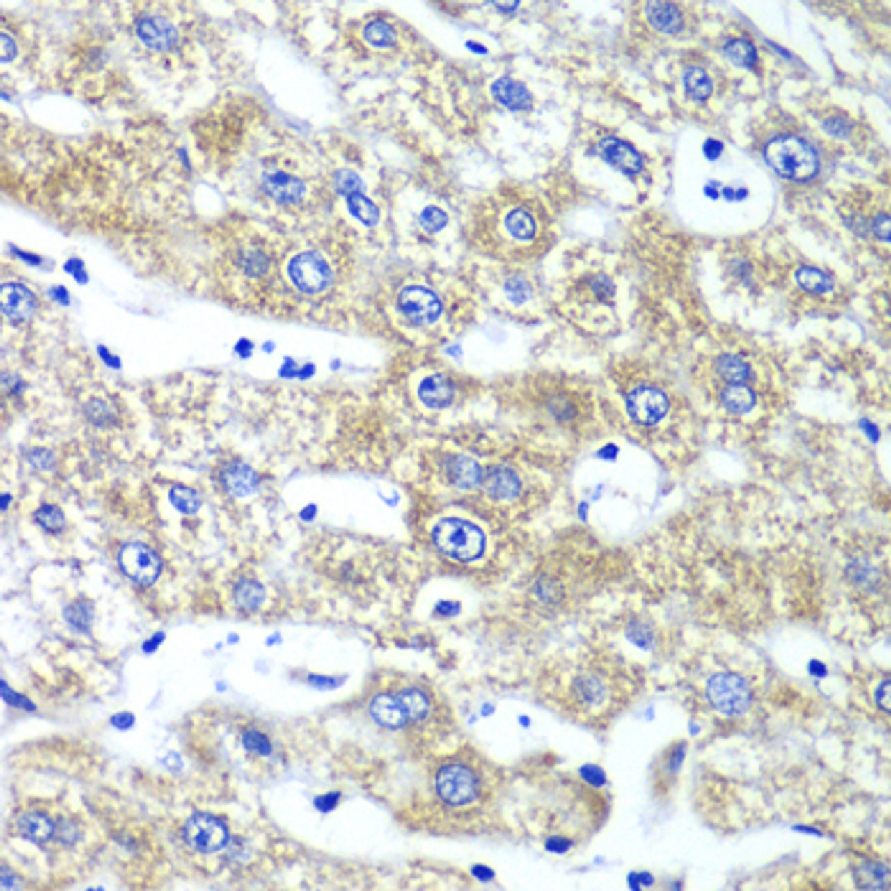 Immunohistochemistry of paraffin-embedded Human liver damage using QARS Polyclonal Antibody at dilution of  1:100 (40x lens).