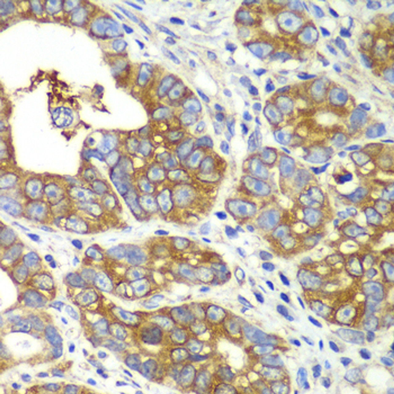 Immunohistochemistry of paraffin-embedded Human gastric cancer using QARS Polyclonal Antibody at dilution of  1:100 (40x lens).