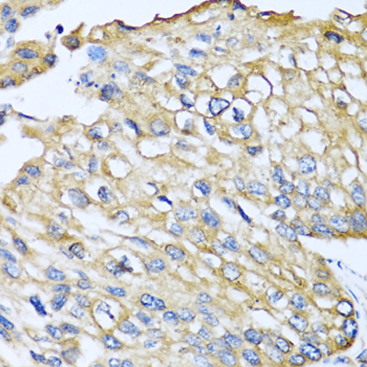 Immunohistochemistry of paraffin-embedded Human prostate cancer using CCL8 Polyclonal Antibody at dilution of  1:100 (40x lens).