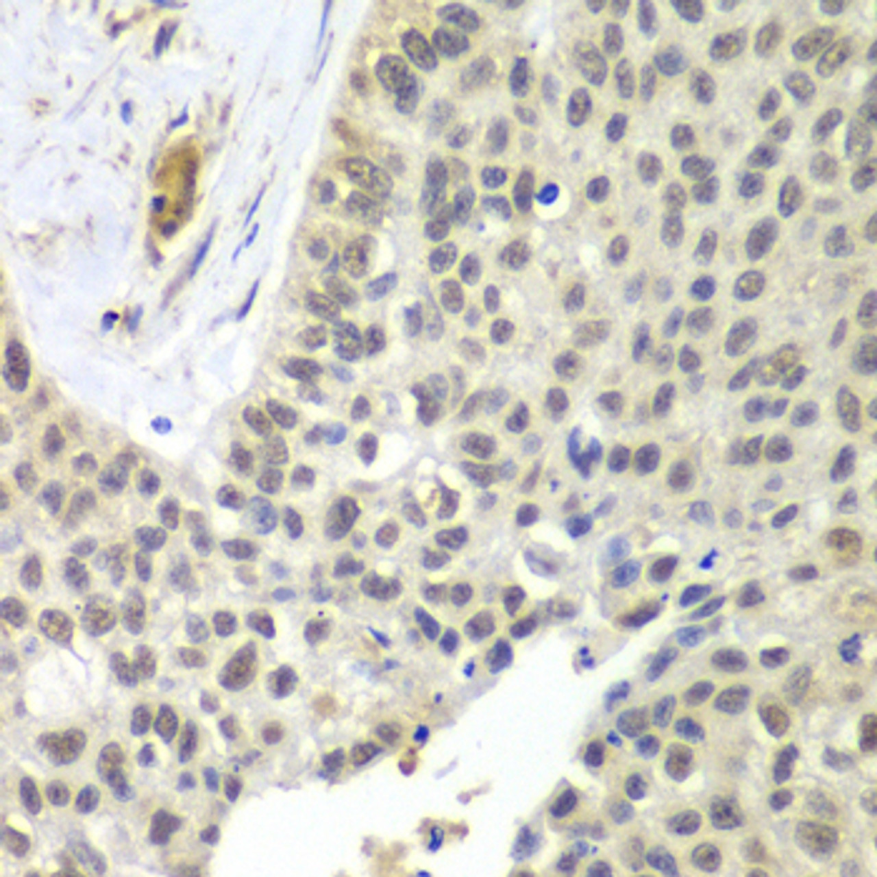 Immunohistochemistry of paraffin-embedded Human lung cancer using SNRPD2 Polyclonal Antibody at dilution of  1:100 (40x lens).