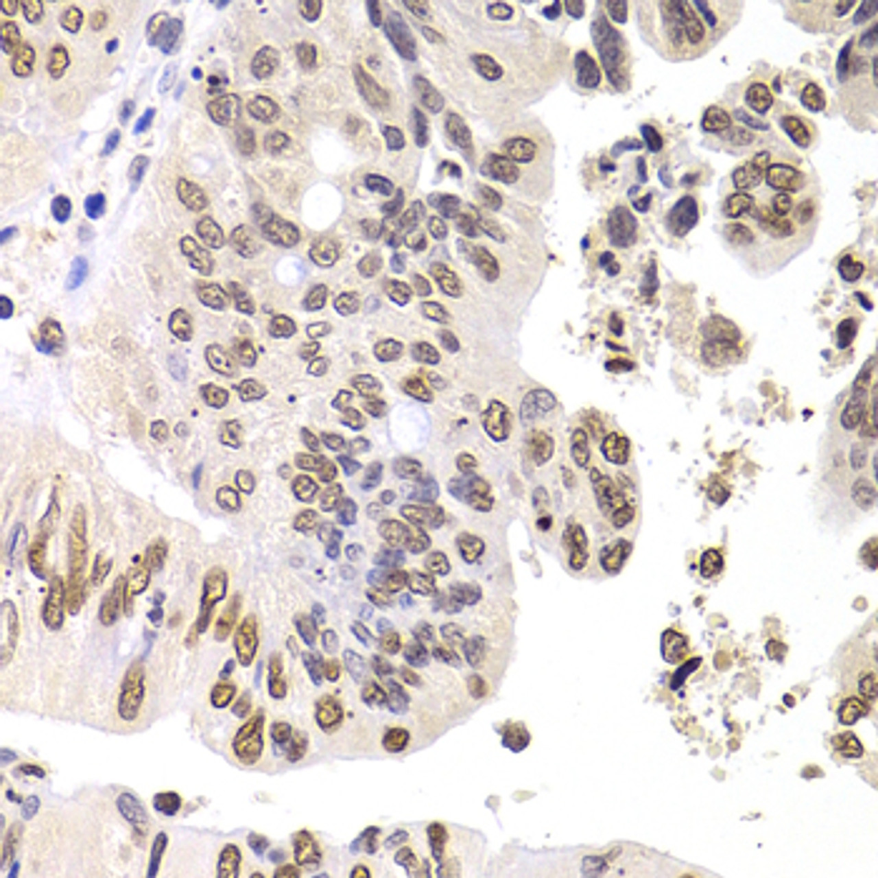 Immunohistochemistry of paraffin-embedded Human colon carcinoma using SOX5 Polyclonal Antibody at dilution of  1:100 (40x lens).