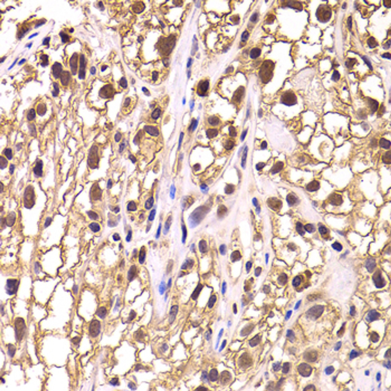 Immunohistochemistry of paraffin-embedded Human kidney cancer using TCEB3 Polyclonal Antibody at dilution of  1:100 (40x lens).