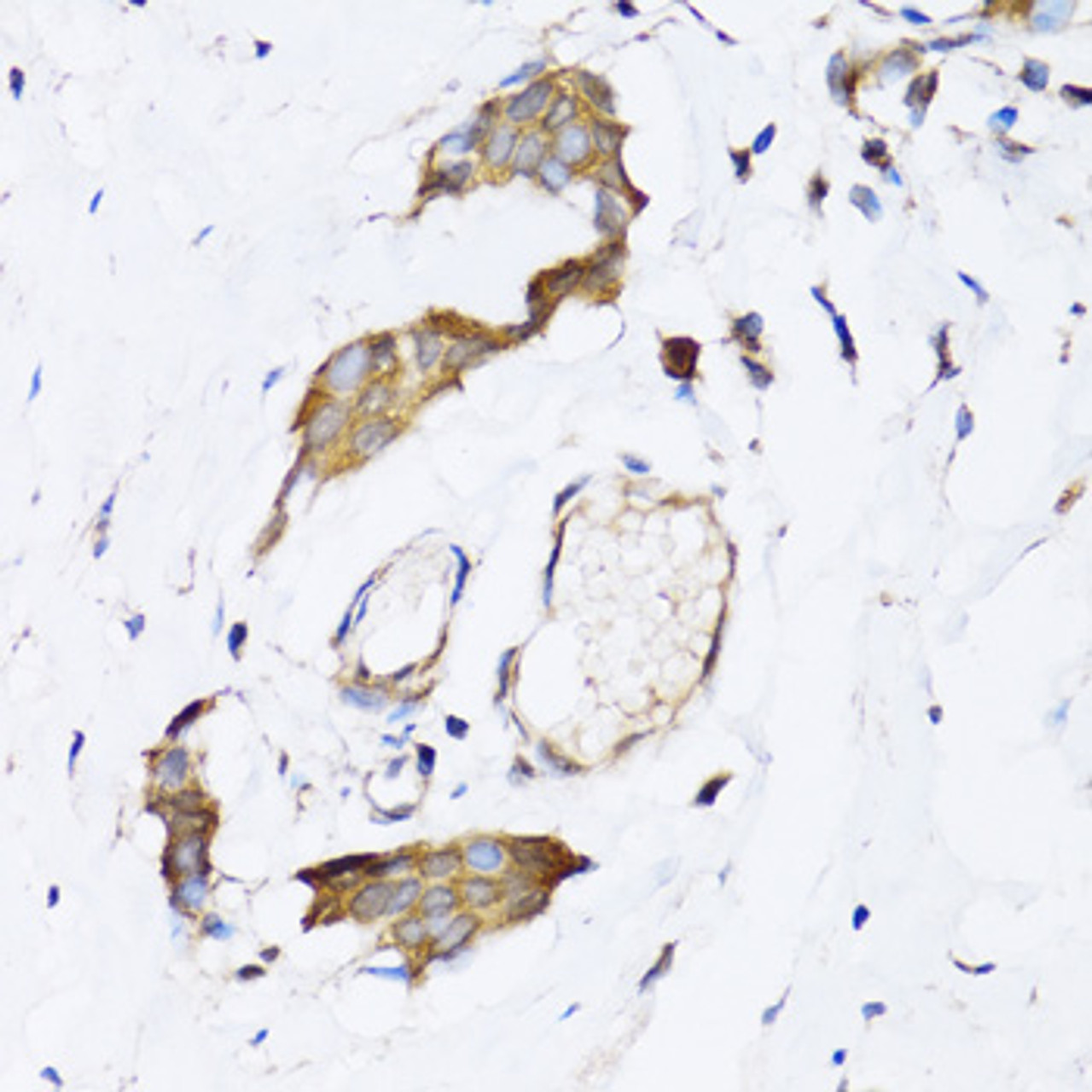Immunohistochemistry of paraffin-embedded Human breast cancer using NAA10 Polyclonal Antibody at dilution of  1:100 (40x lens).