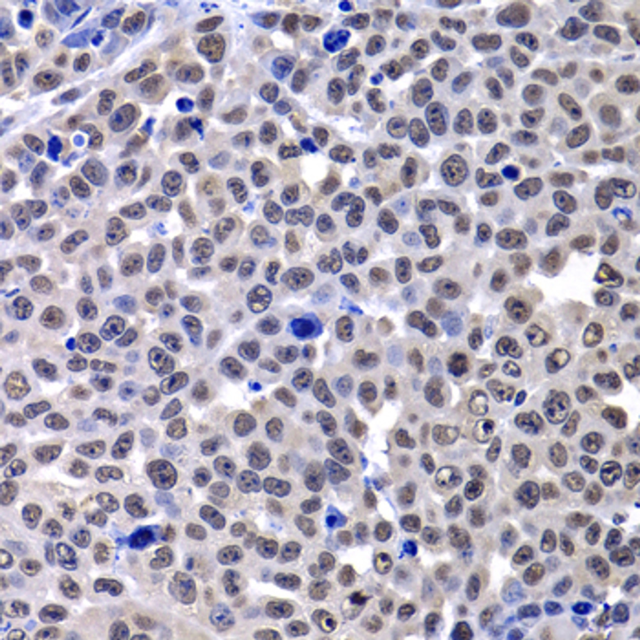 Immunohistochemistry of paraffin-embedded Mouse lung cancer using mH2A1 Polyclonal Antibody at dilution of  1:100 (40x lens).