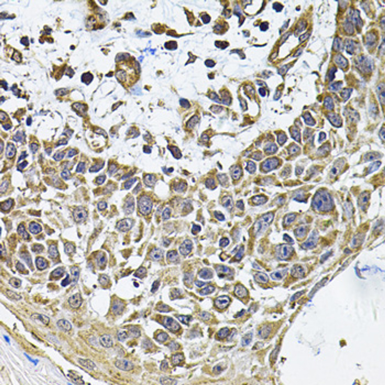 Immunohistochemistry of paraffin-embedded Human skin carcinoma using ICOSL Polyclonal Antibody at dilution of  1:100 (40x lens).