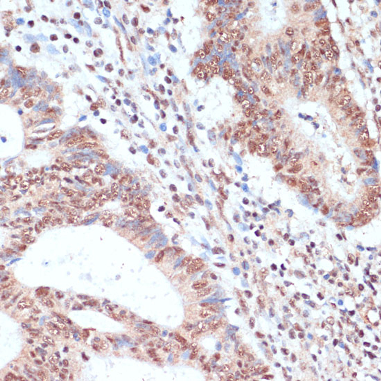 Immunohistochemistry of paraffin-embedded Human colon carcinoma using NAA20 Polyclonal Antibody at dilution of  1:100 (40x lens).