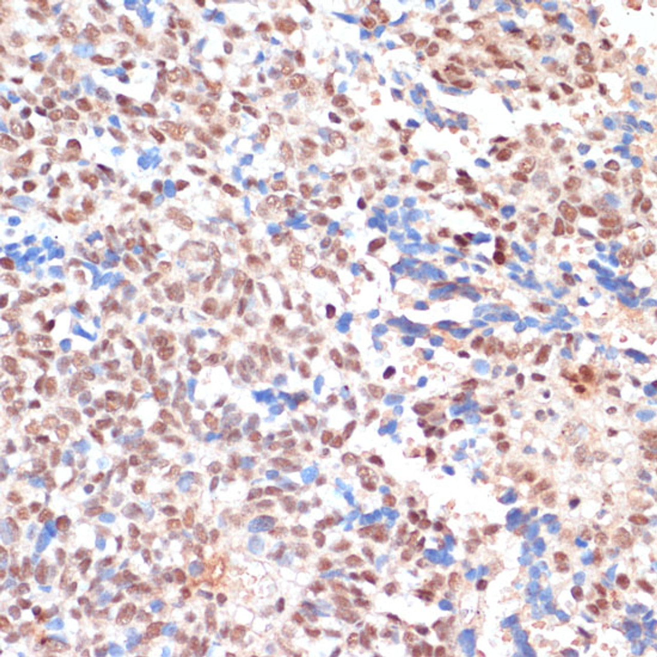 Immunohistochemistry of paraffin-embedded Human oophoroma using NAA20 Polyclonal Antibody at dilution of  1:100 (40x lens).