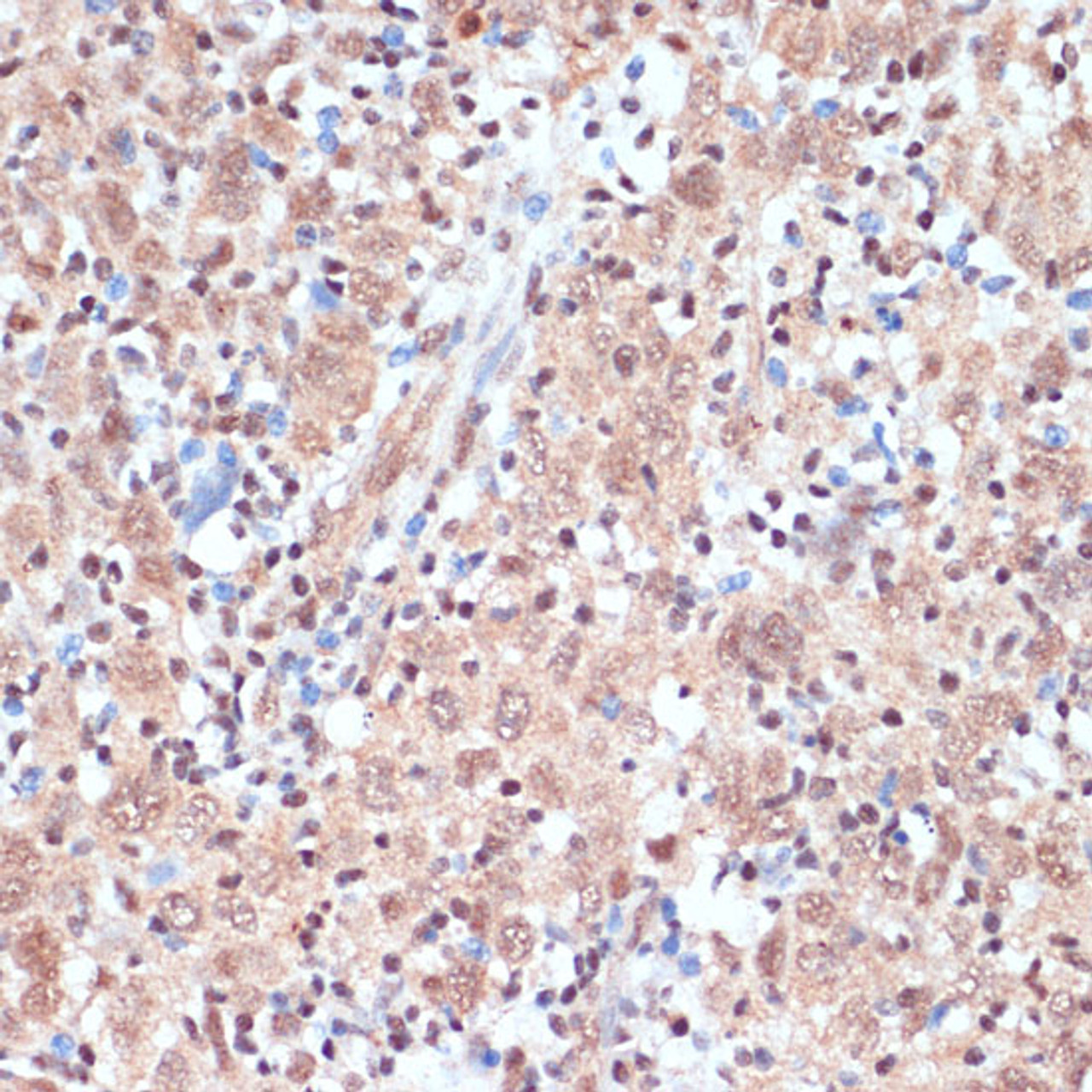 Immunohistochemistry of paraffin-embedded Human esophageal cancer using NAA20 Polyclonal Antibody at dilution of  1:100 (40x lens).