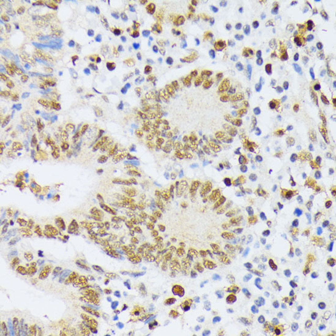 Immunohistochemistry of paraffin-embedded Human colon carcinoma using ELAC2 Polyclonal Antibody at dilution of  1:200 (40x lens).