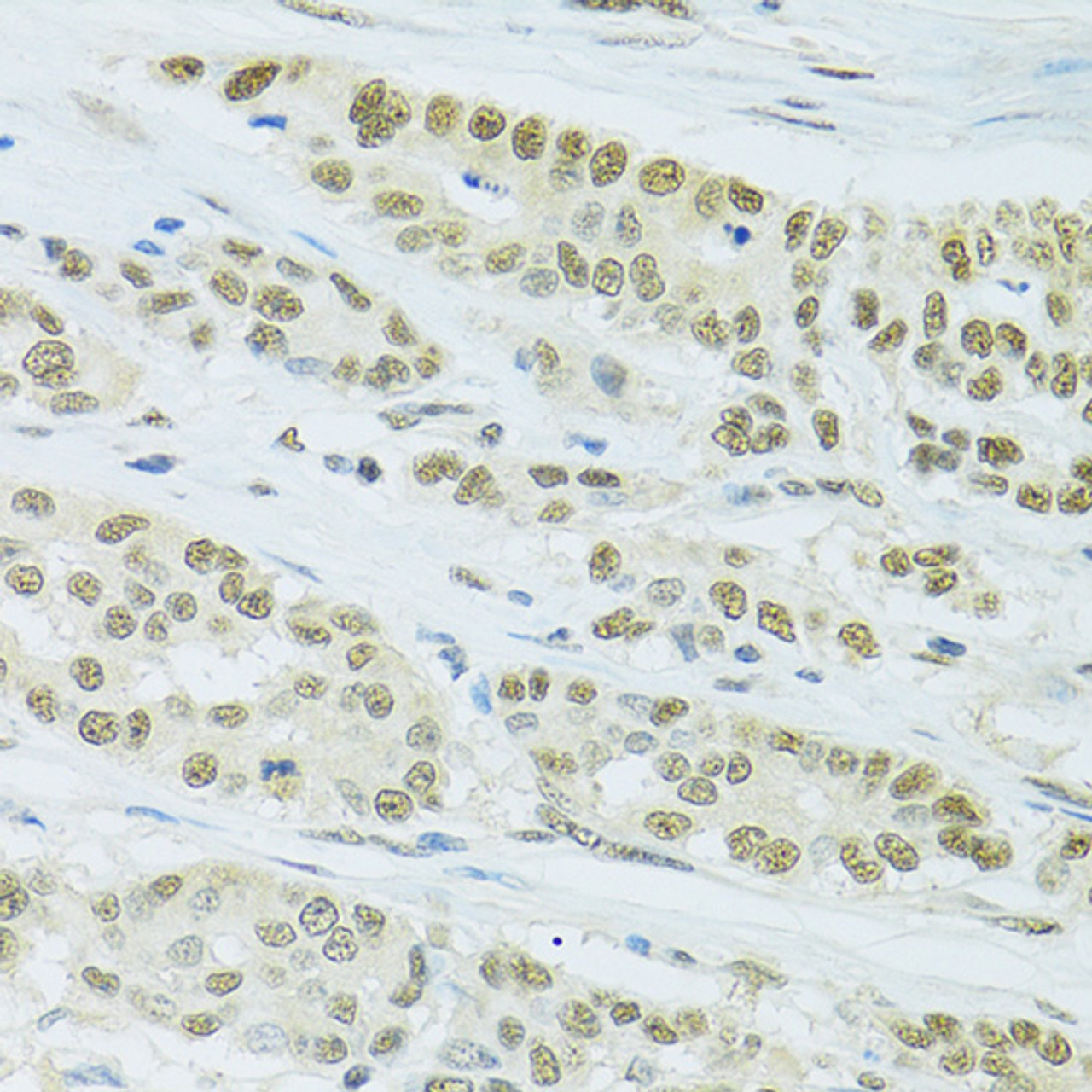 Immunohistochemistry of paraffin-embedded Human colon carcinoma using FIP1L1 Polyclonal Antibody at dilution of  1:100 (40x lens).