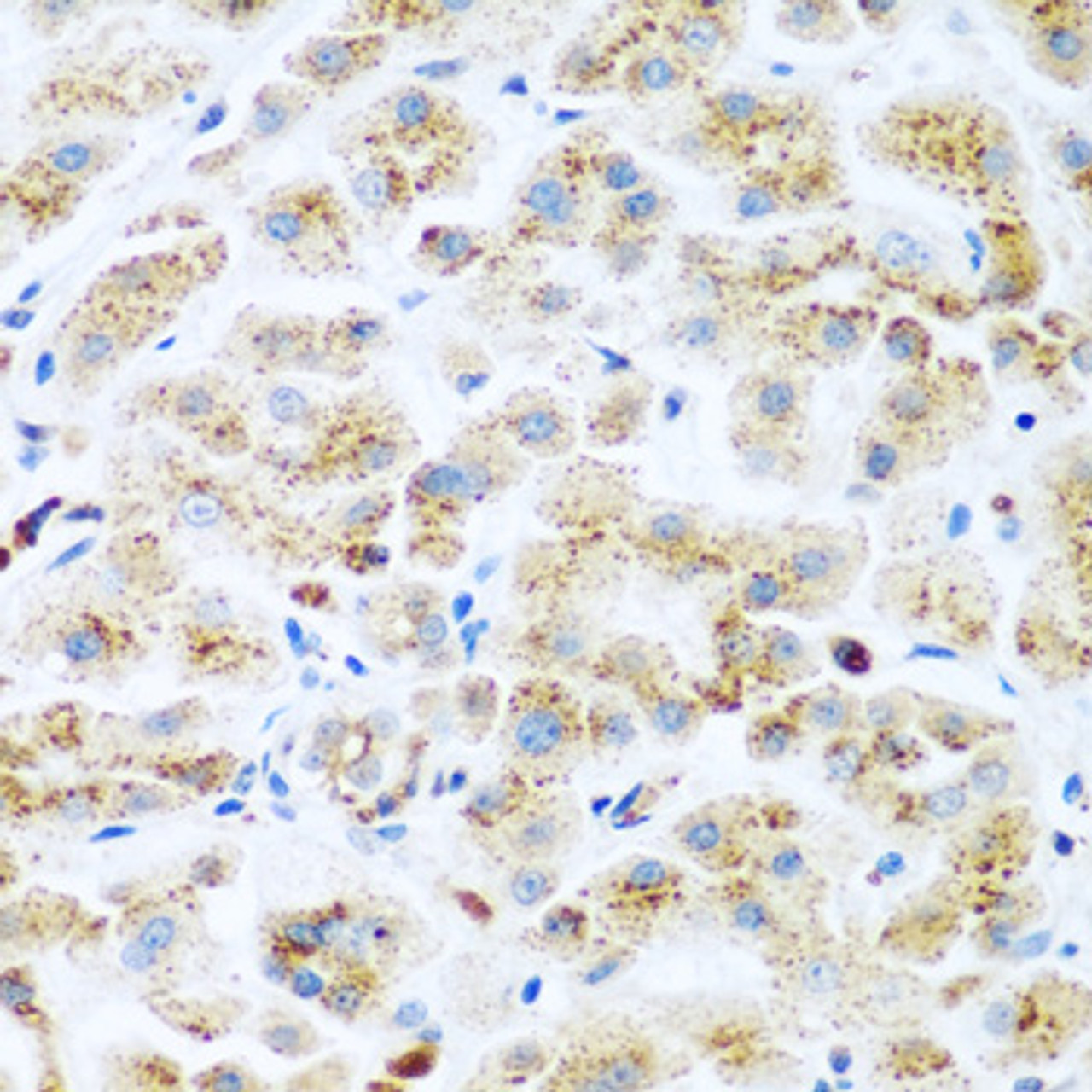 Immunohistochemistry of paraffin-embedded Human liver cancer using KIAA1456 Polyclonal Antibody at dilution of  1:200 (40x lens).