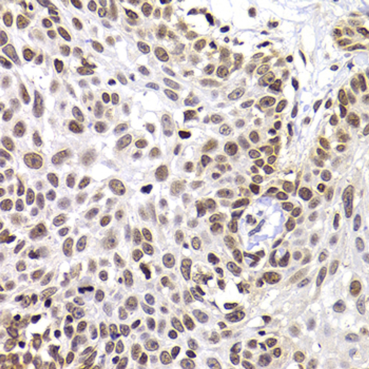 Immunohistochemistry of paraffin-embedded Human well-differentiated squamous skin carcinoma using PHIP Polyclonal Antibody at dilution of  1:100 (40x lens).