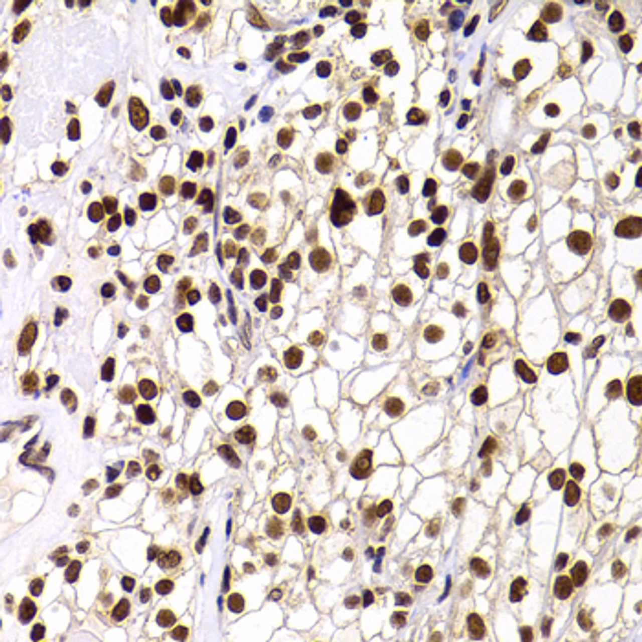 Immunohistochemistry of paraffin-embedded Human kidney cancer using PHIP Polyclonal Antibody at dilution of  1:100 (40x lens).