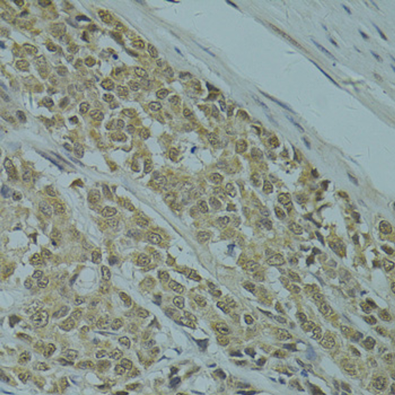 Immunohistochemistry of paraffin-embedded Human colon carcinoma using RSRC1 Polyclonal Antibody at dilution of  1:100 (40x lens).