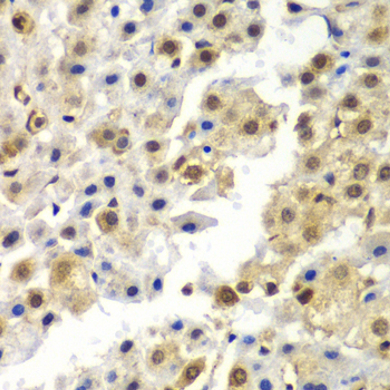 Immunohistochemistry of paraffin-embedded Human liver cancer using SYNCRIP Polyclonal Antibody at dilution of  1:100 (40x lens).