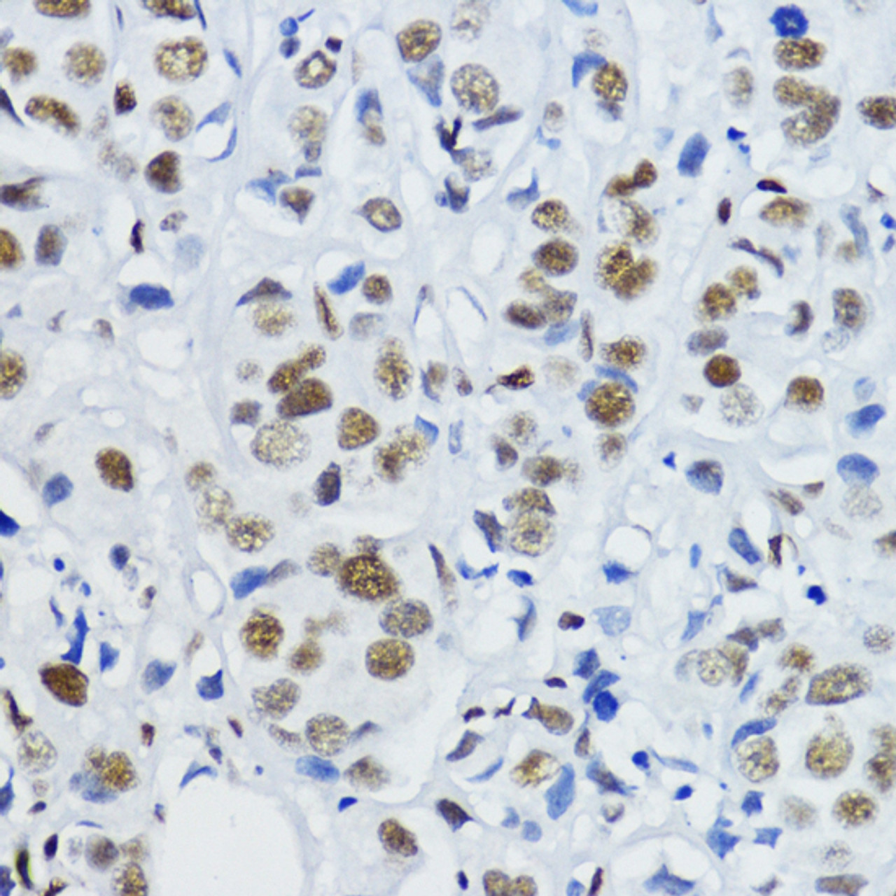 Immunohistochemistry of paraffin-embedded Human mammary cancer using Acetyl-Histone H3-K27 Polyclonal Antibody at dilution of  1:200 (40x lens).