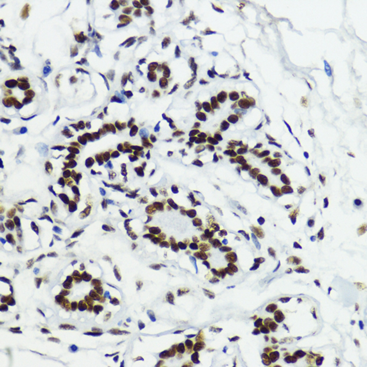 Immunohistochemistry of paraffin-embedded Human breast using Acetyl-Histone H3-K27 Polyclonal Antibody at dilution of  1:200 (40x lens).