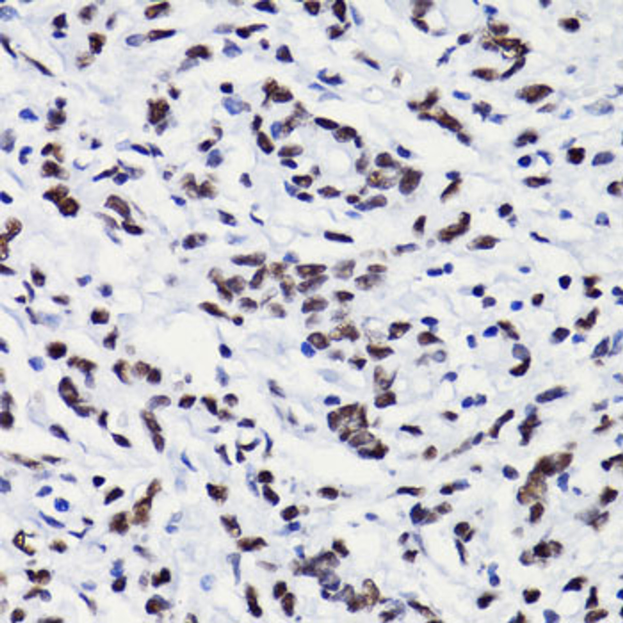 Immunohistochemistry of paraffin-embedded Human gastric cancer using Acetyl-Histone H3-K18 Polyclonal Antibody at dilution of  1:100 (40x lens).