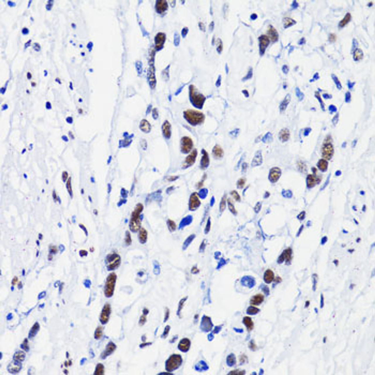 Immunohistochemistry of paraffin-embedded Human gastric cancer using Acetyl-Histone H4-K8 Polyclonal Antibody at dilution of  1:100 (40x lens).